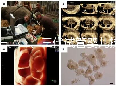 一、二、三代試管嬰兒技術(shù)的區(qū)別，看完你就知道了！