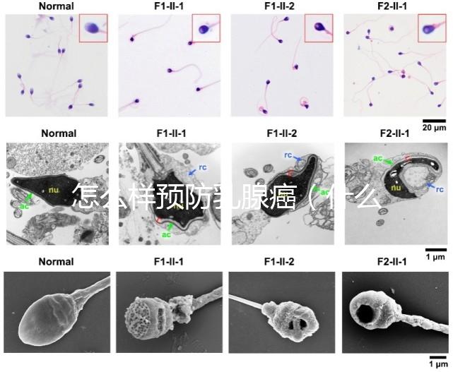 怎么樣預(yù)防乳腺癌（什么人容易得乳腺癌）