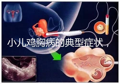 小兒雞胸病的典型癥狀，早發現早治療很重要！