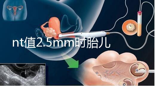 nt值2.5mm時(shí)胎兒異常幾率并不高，但羊水穿刺一定要做